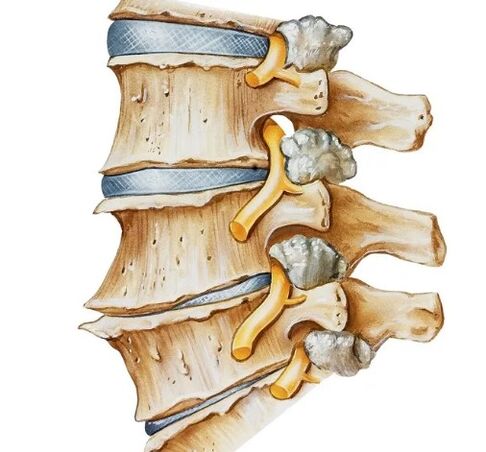 Apriete el nervio en la columna vertebral