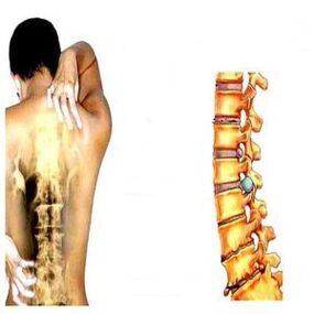 Estadios de osteocondrosis