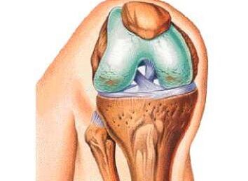 Las principales causas de la osteoartritis de rodilla