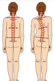 Escoliosis