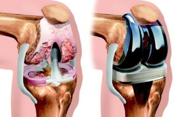 Antes y después de los endoprotéticos de la articulación de la rodilla con osteoartritis