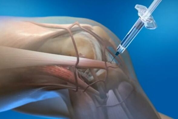 inyecciones intrakarticulares para la artrosis de la articulación de la rodilla