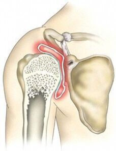 Destrucción de la articulación del hombro por osteoartritis.