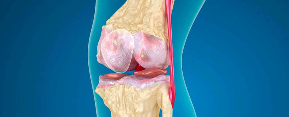 Osteoartritis de la articulación de la rodilla.