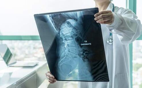 La radiografía es un método de diagnóstico necesario cuando duele la espalda. 