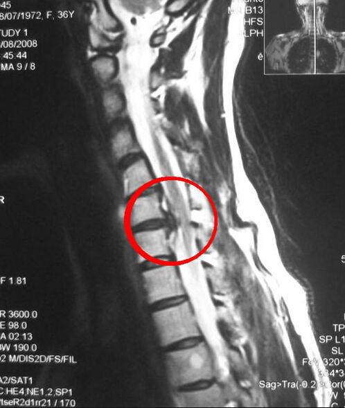 Síntomas de osteocondrosis torácica en radiografía. 
